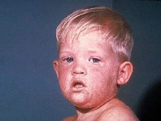 Measles Rash on Face