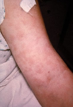 Penicillin Rash on the Arm